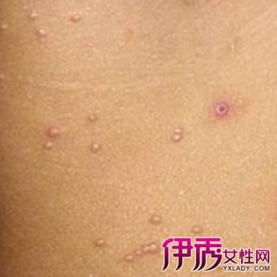 图女性尖锐湿疣初期症状图片了解常见的3种症状