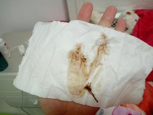 但是身底下每天就流这么一点褐色分泌物里面有白带和褐色的血丝,每天