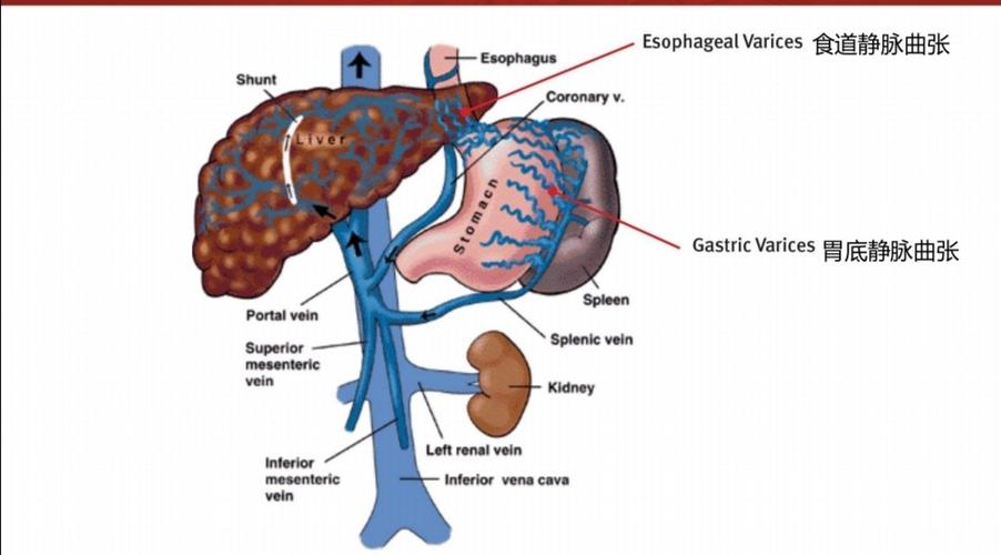 tips治疗肝硬化伴食管胃底静脉曲张出血一例
