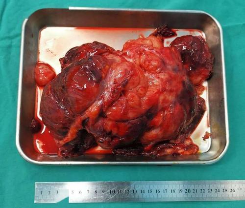 贵州省肿瘤医院泌尿外科完成一例腹膜后恶性肿瘤切除术