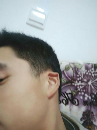 耳朵轮廓软骨先天性骨折怎么办