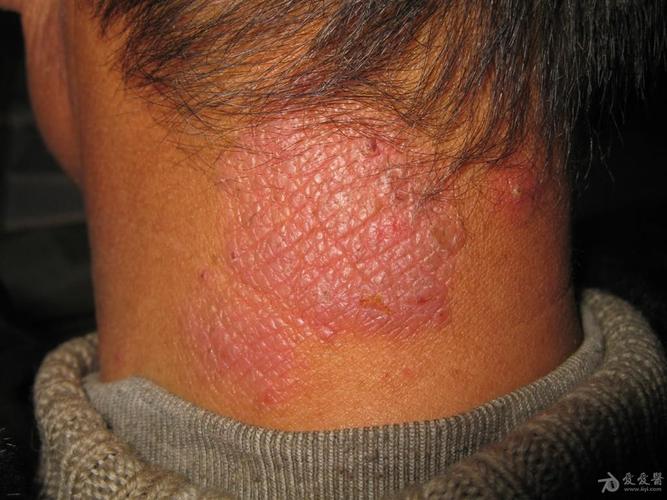 这是什么皮肤病神经性皮炎