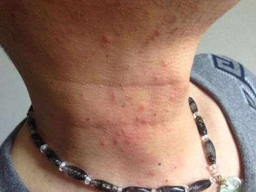 身上起红疙瘩很痒怎么办