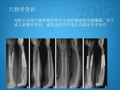 尺桡骨骨折ppt课件