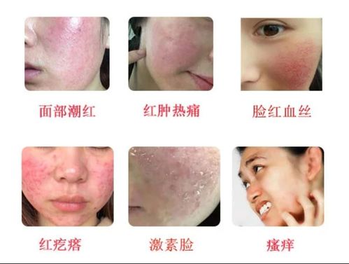 如何辨认激素脸?了解痘痘常识,闭合性粉刺的成因.