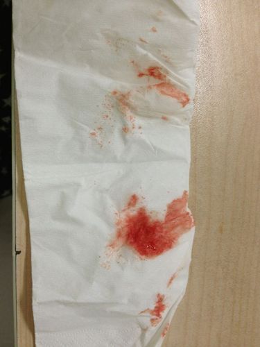 醒鼻涕有血是什么情况,见图.