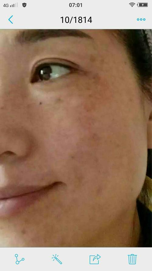 谁知道我下巴上和脸颊边上那块黑色得斑是什么!是痘痘