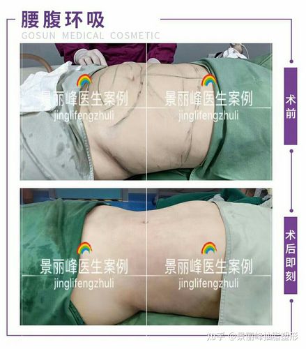 腰腹环吸案例反馈大基数抽脂效果立竿见影不仅视觉上瘦了腰身也显现了