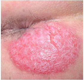 肛周湿疹怎样能治好