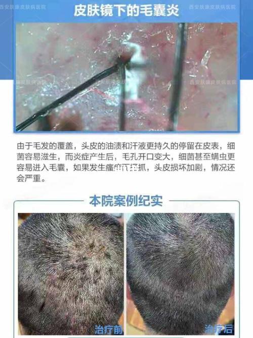 毛囊炎是什么症状?_毛囊炎_痘痘_头皮毛囊炎_医疗健康