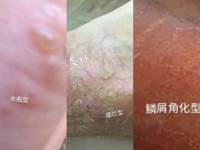 3,鳞屑角化型 症状是足跖,足缘,足跟部皮肤脚趾增厚,粗糙,脱屑,反复