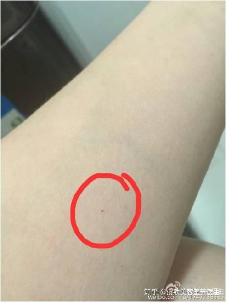 今天讲一讲最常见的一种血管瘤——樱桃样血管瘤.