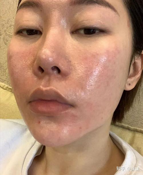 我是六年的激素脸,曾经最严重的时候脸上流黄水起红疹子,一度自卑到