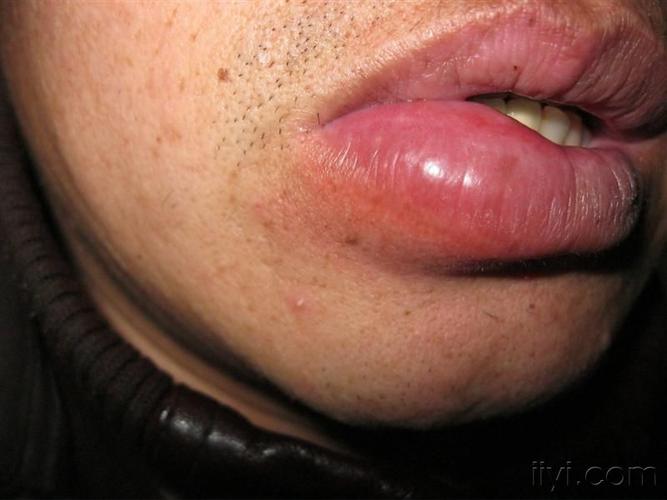 口唇血管性水肿病例