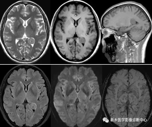 侧脑室三角区肿瘤的诊断