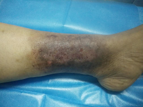 糖尿病足坏疽怎么治疗和护理,糖尿病脚刚开始的图片有