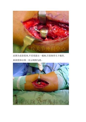 doc  桡骨小头假体 手术方法 1 患者仰卧位或侧卧位,患肢在上,消毒患