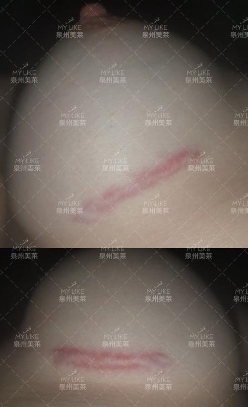 隆胸后增生性瘢痕最佳的治疗方法是?