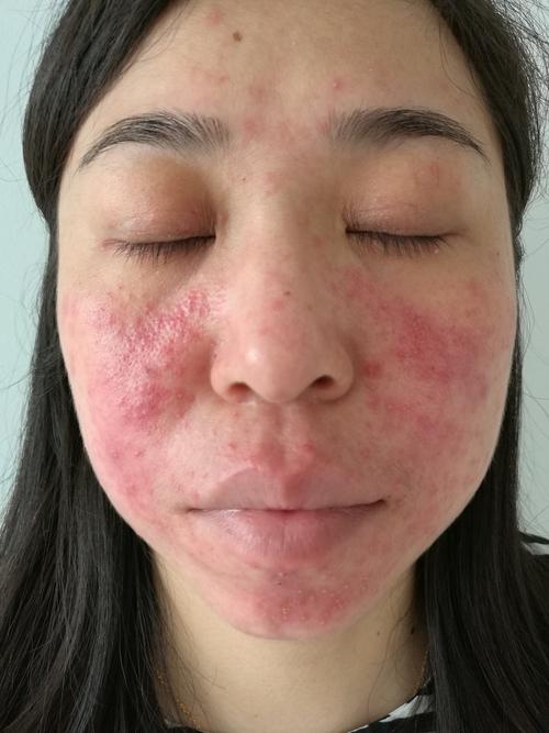面部激素依赖性皮炎能治好,疗效看这里!