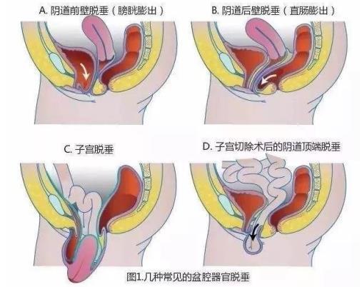 为子宫脱垂患者解除难言之隐