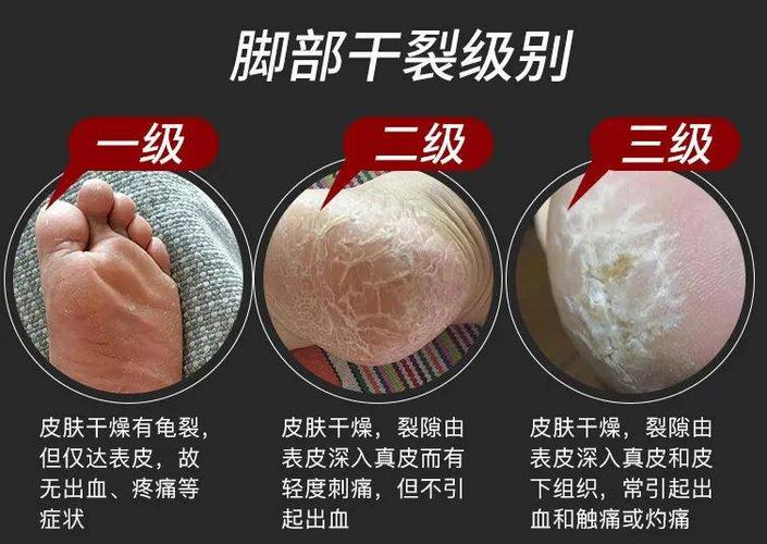 脚后跟总是干裂,起皮的人,一定要注意这几件事!