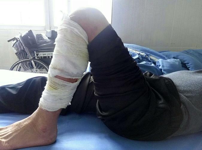 关节粘连松解术治疗膝关节功能障碍,效果显著