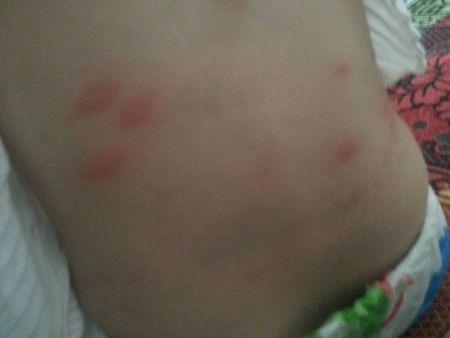 问:宝宝.2个月前湿疹要起水泡.前10多天都没什么了,这两天身上又发了.