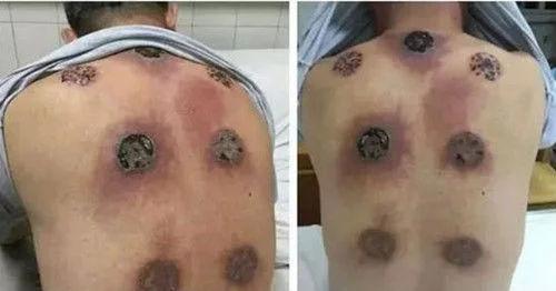 男子太累了去做拔火罐,第二天一看背部的痕迹,顿时崩溃不已
