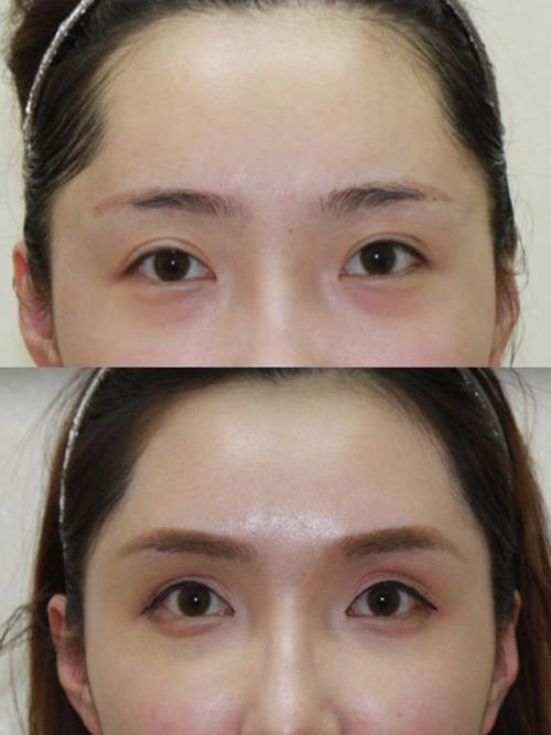 9595眉弓属于_圈子-新氧美容整形