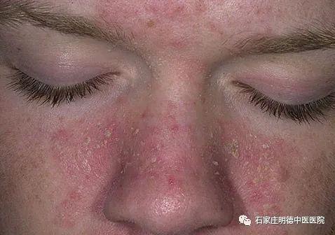 脂溢性皮炎的症状和治疗方法