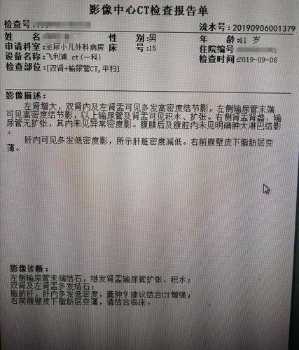 左侧输尿管镜下激光碎石 尿管支架植入术1例 - 病例()