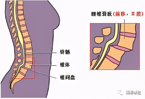 腰椎滑脱不能拖需尽早治疗