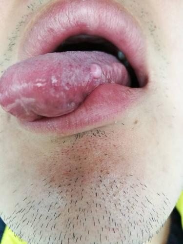 我的舌头上长了一个豆大的疙瘩,请看图片给我解释一下