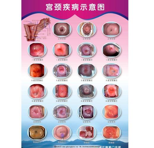 其它 hpv相关知识 写美篇 宫颈糜烂 宫颈肥大 宫颈息肉 宫颈纳氏囊肿
