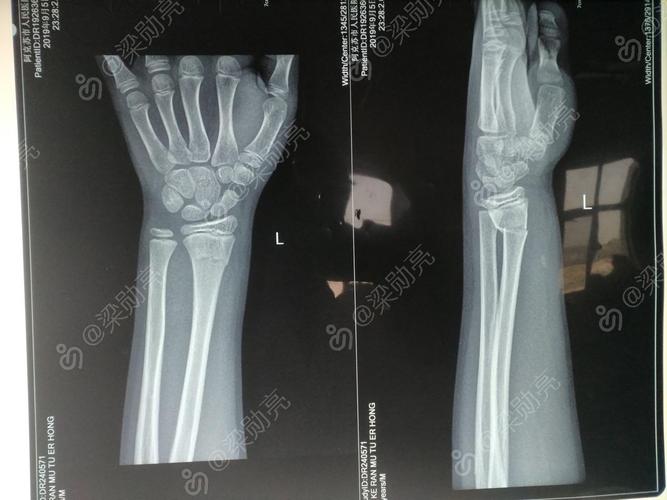 儿童桡骨远端骨折手法复位杉树皮小夹板外固定治疗