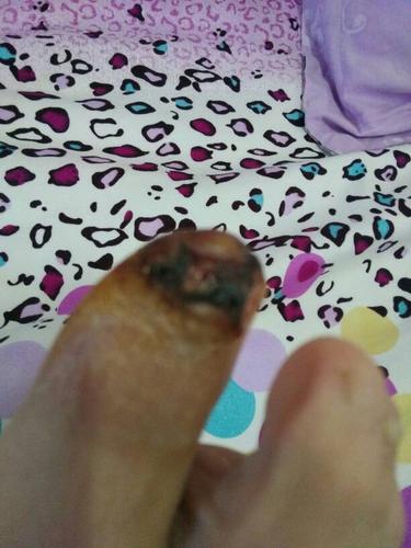 我是2.17号早上上班中,店铺墙壁上的玻璃突然坠落,砸伤脚趾,以