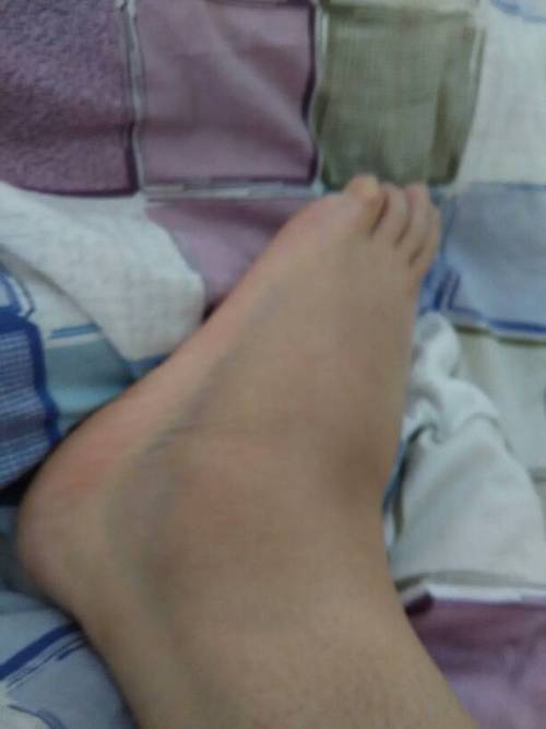 崴脚50小时,不疼能走不敢吃劲,左脚在侧脚面青了,微肿,刚崴时可持重