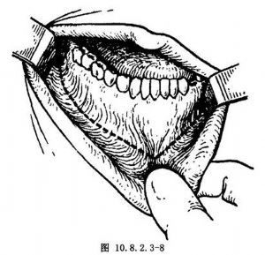 自患侧下颌磨牙后区至对侧牙区作一水平前庭沟切口直达骨膜.