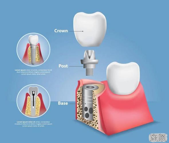 种植牙基台是什么?有哪些种类?应该怎么选?