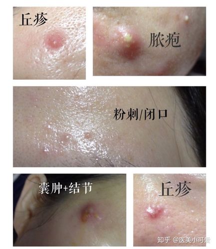 粉刺型?丘疹型还是囊肿型?各种