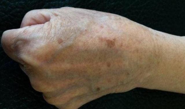 艾滋病出现前皮肤会有哪些症状若发现这些情况不要忽视