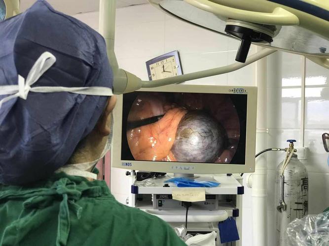 区医院妇产科成功完成腹腔镜下双侧巨大巧克力囊肿剔除术一例