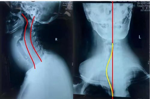 甲状腺巨大肿物导致困难气管插管一例