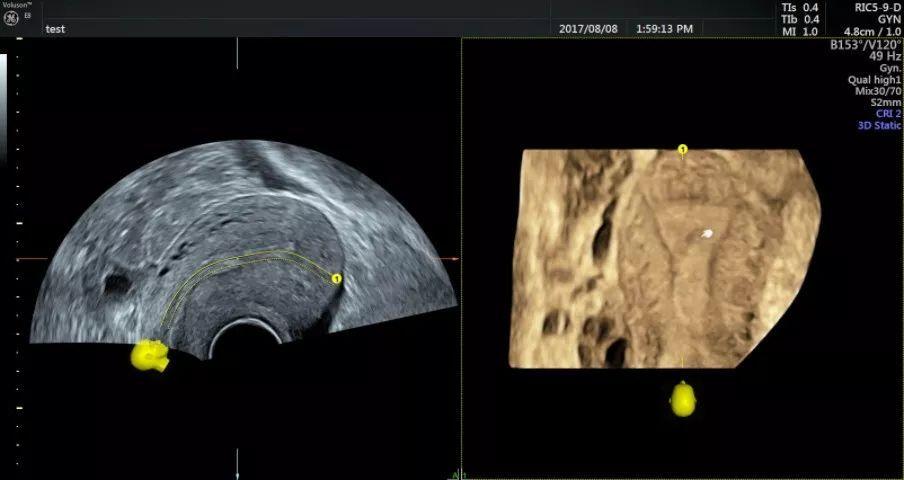 图为轻度宫腔粘连,小手指指向缺损部分三,子宫内膜息肉子宫内膜息肉