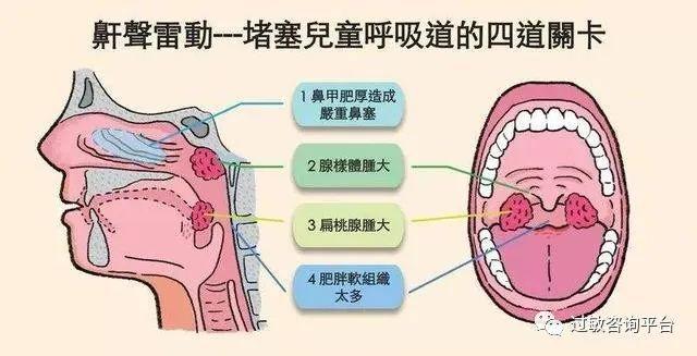 什么是腺样体肥大的罪魁祸首?有哪些危害?