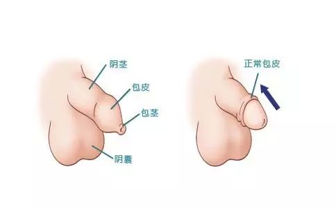手术室里迎来了一波又一波的"包皮大军",宝宝包皮长不长,是不是包茎?