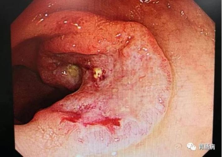 距肛门17-20cm处φ3cm之溃疡性病变