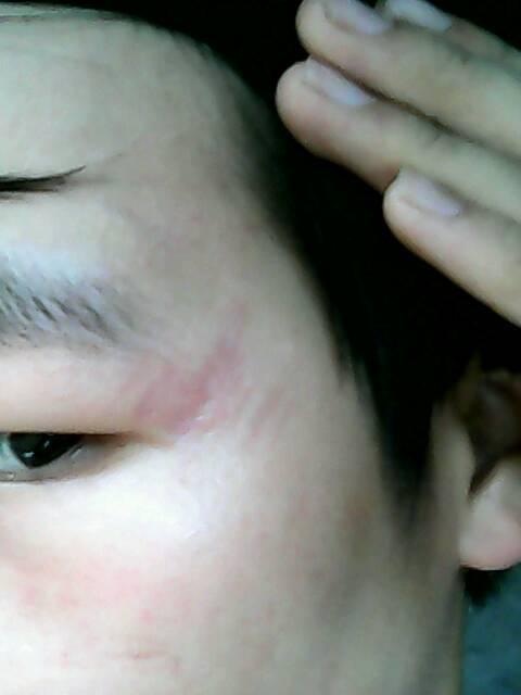 如果不是增生的疤痕,一般6个月后就成熟了,颜色变白