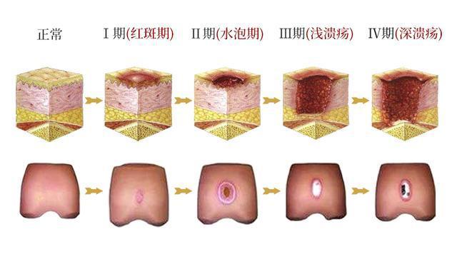 出现这些症状要提高警惕了|溃疡|褥疮||炎