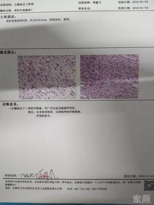 应用复合手术方式成功治疗一例罕见颌面部神经纤维瘤合并出血患者
